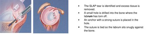 slap lesion treatment